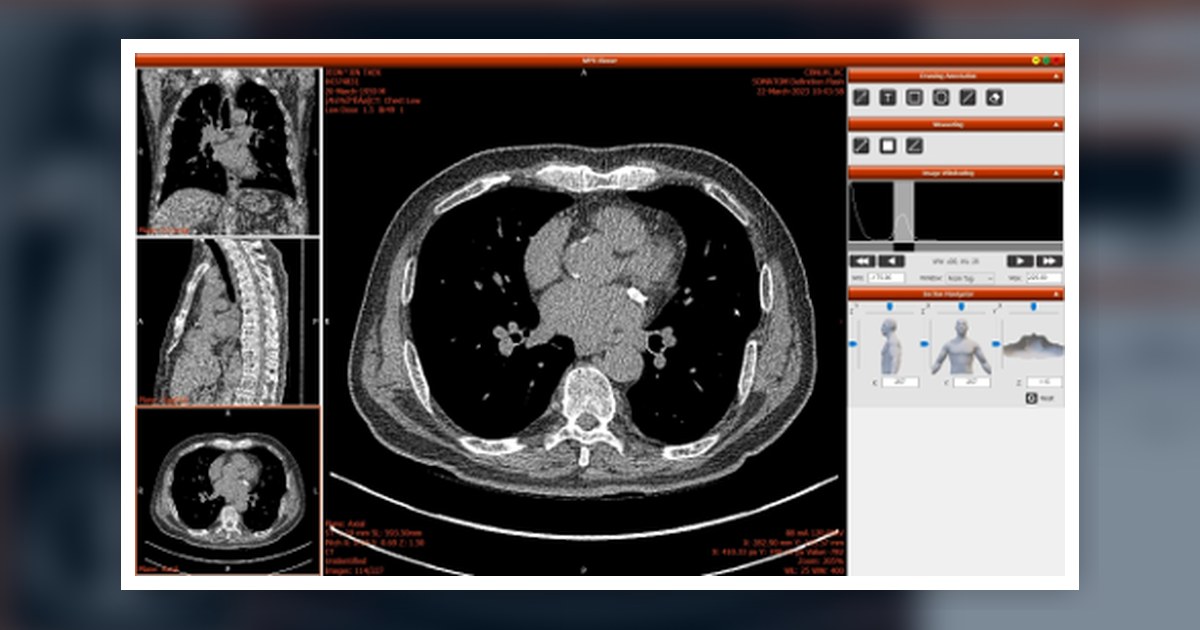 HEXA AI chest CT analysis software interface showing lung CT scan review